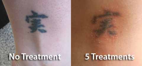 Ink Regret | my personal experience with laser tattoo removal | Page 2